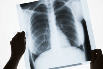 Фотография к новости: 82-летнюю бабушку с поражением 90 процентов легких вылечили в Шымкенте