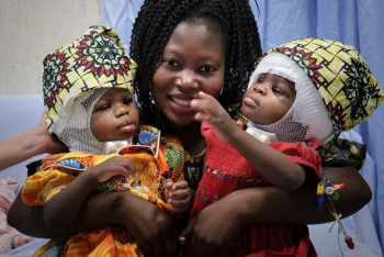 Фотография к новости: Врачам удалось разделить сросшихся головами сестер
