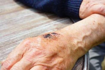 Фотография к новости: У двух жителей Шымкента обнаружили сибирскую язву