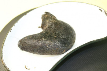 Фотография к новости: Килограмм волос удалили из желудка у алматинки