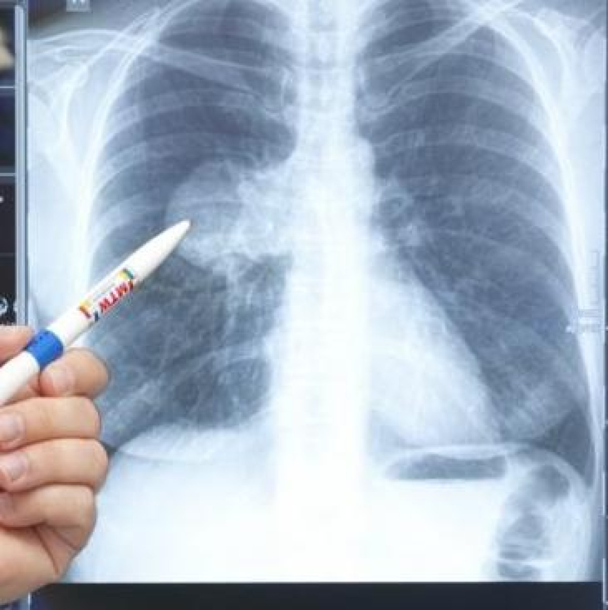 Число заболевших коронавирусной пневмонией в РК достигло 40 197