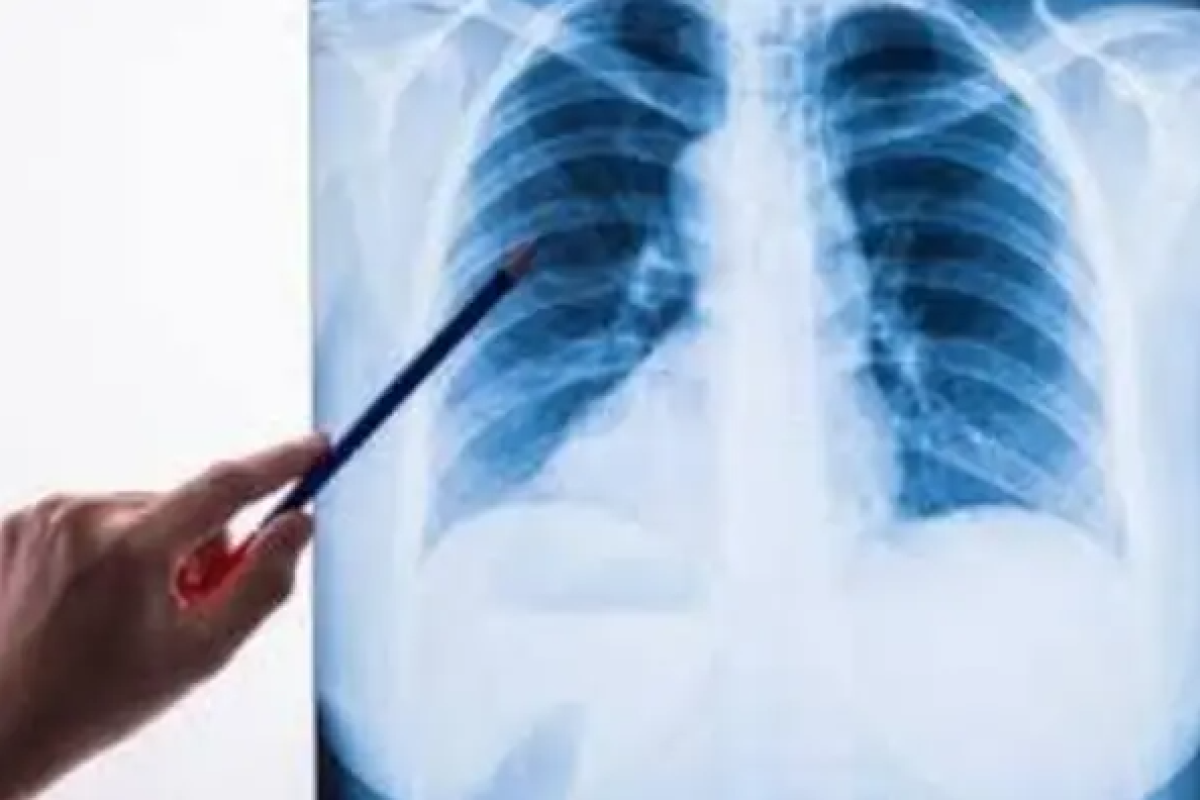 Пневмония с признаками коронавируса: 22 заболевших, двое умерших за сутки