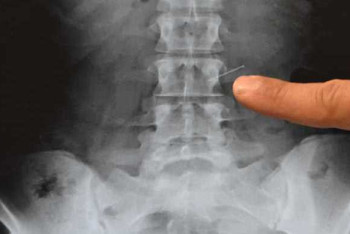 Фотография к новости: Осужденный наглотался иголок и гвоздей в СИЗО Караганды