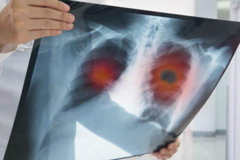 Фотография к новости: Девять симптомов рака легких назвали ученые