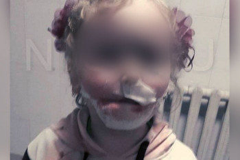 Фотография к новости: Собака откусила губу шестилетней девочке