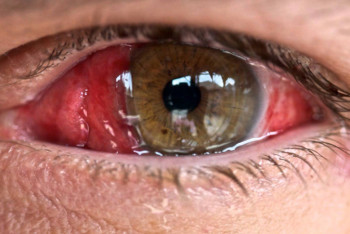 Фотография к новости: Экзамен под кварцем: с какими последствиями могут столкнуться пострадавшие