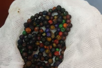 Фотография к новости: Хирурги Нур-Султана прооперировали проглотившую более 100 магнитов девочку