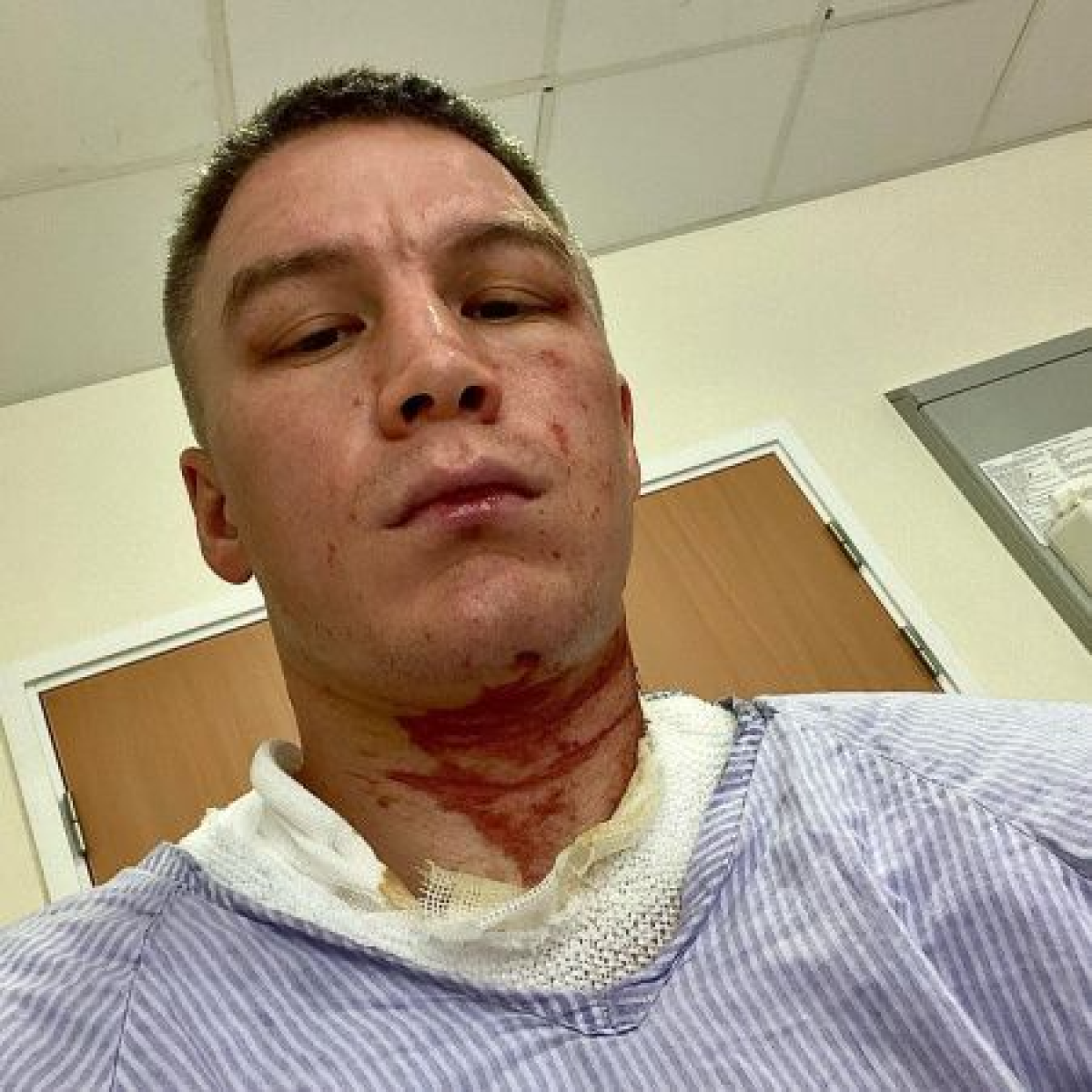 Казахстанского боксера облили кислотой: спортсмен рассказал о своем состоянии
