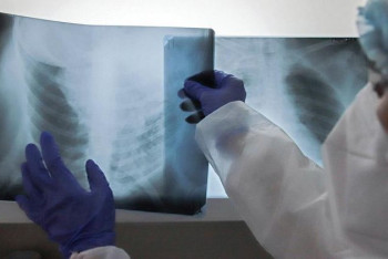 Фотография к новости: Врач назвал людей, предрасположенных к новому симптому КВИ