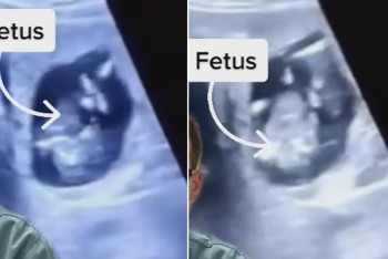 Фотография к новости: В печени женщины обнаружили растущий эмбрион