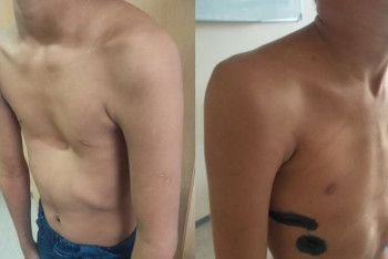 Фотография к новости: Ребенка с деформацией грудной клетки прооперировали врачи Алматы