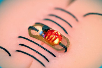 Фотография к новости: "Умные" швы будут следить за последствиями хирургических операций