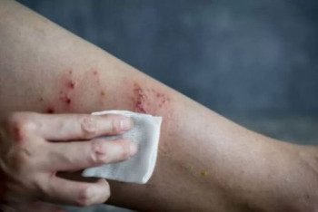 Фотография к новости: Два случая оспы обезьян выявлены в Аргентине