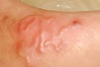 Фотография к новости: Червя обнаружили под кожей у жителя Уральска