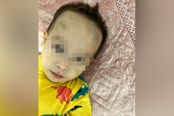 Фотография к новости: Двухлетний ребёнок вернулся из садика с сотрясением мозга