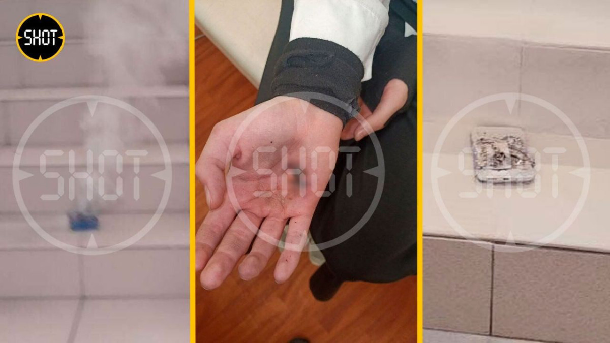 Школьница получила ожоги после взрыва смартфона в кармане