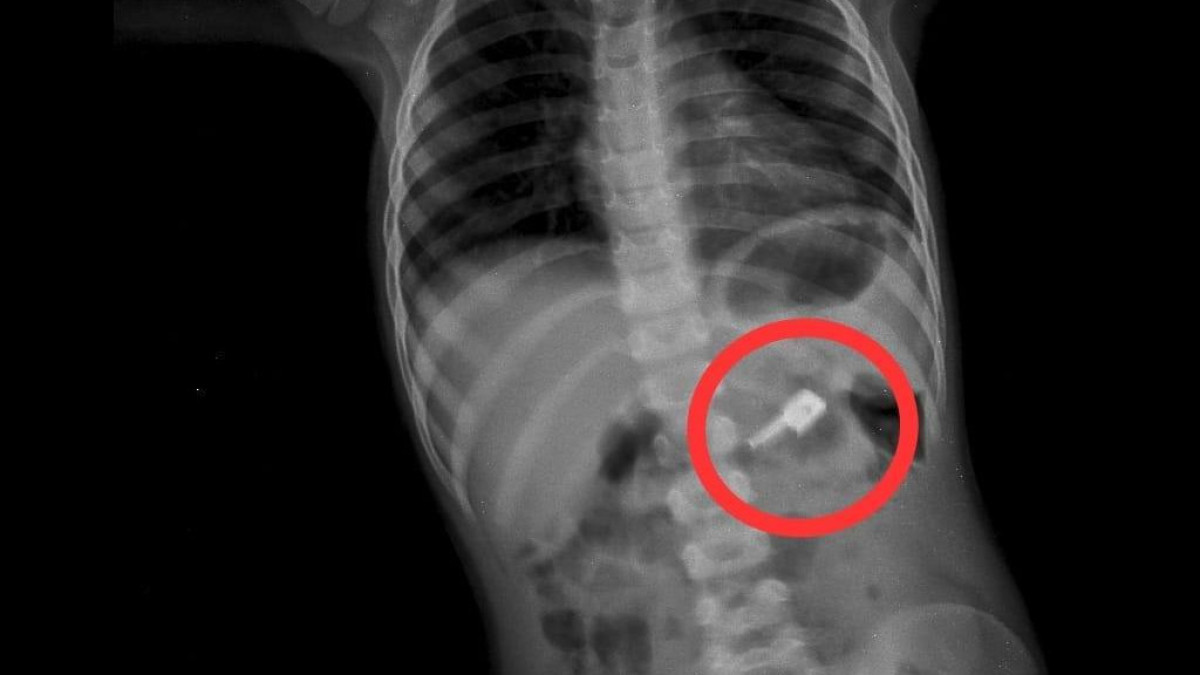 Четыре иглы и застёжку от молнии проглотил ребёнок в Таразе
