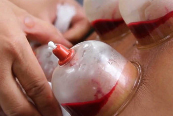 Фотография к новости: Министр здравоохранения высказалась о хиджаме новорождённым