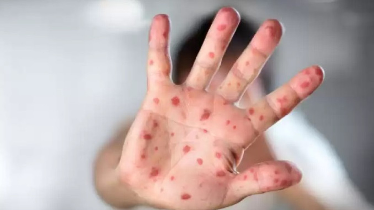 Эпидемиологическая ситуация по кори усложнилась в Казахстане