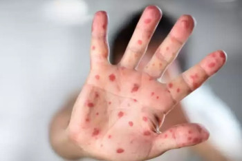 Фотография к новости: Эпидемиологическая ситуация по кори усложнилась в Казахстане