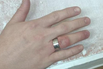 Фотография к новости: Снять кольцо с опухшего пальца помогли павлодарцу спасатели