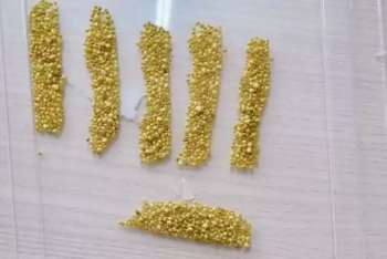 Фотография к новости: Более 1700 камней достали из желчного пузыря женщины в Алматы