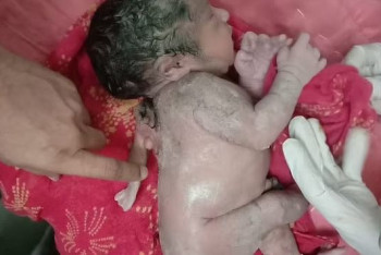 Фотография к новости: Ребёнок родился с тремя руками в Индии