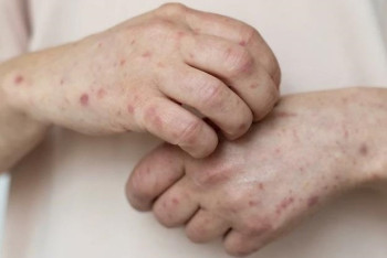 Фотография к новости: Санврачи ожидают ухудшения ситуации с корью в Костанайской области