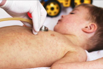 Фотография к новости: Заболеваемость корью растёт в Костанайской области