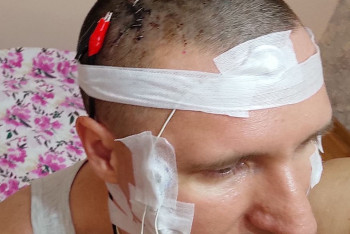 Фотография к новости: Проживающий в Алматы россиянин чипировал себе мозг дрелью