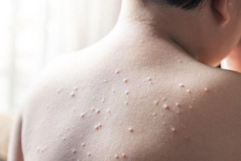 Фотография к новости: В Шымкенте растет количество заболевших корью