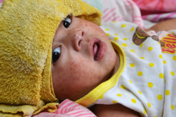 Фотография к новости: Отказались от вакцинации: заболеваемость корью растёт в ЗКО