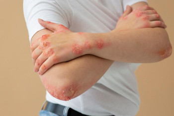 Более 500 казахстанцев прошли инновационное лечение для борьбы с псориазом