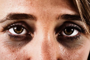 Фотография к новости: О чём могут рассказать тёмные круги под глазами —  мнение врача