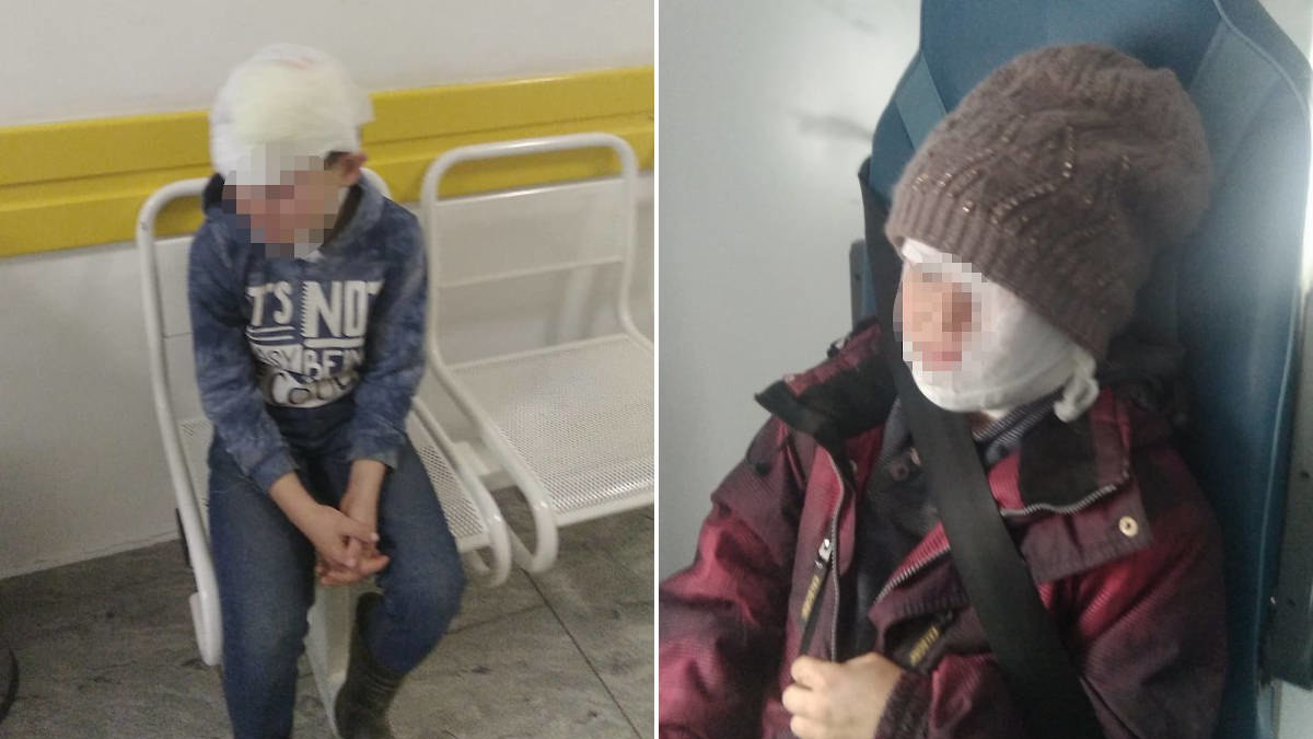 Остались со шрамами на лице: соседская собака покусала детей в ВКО