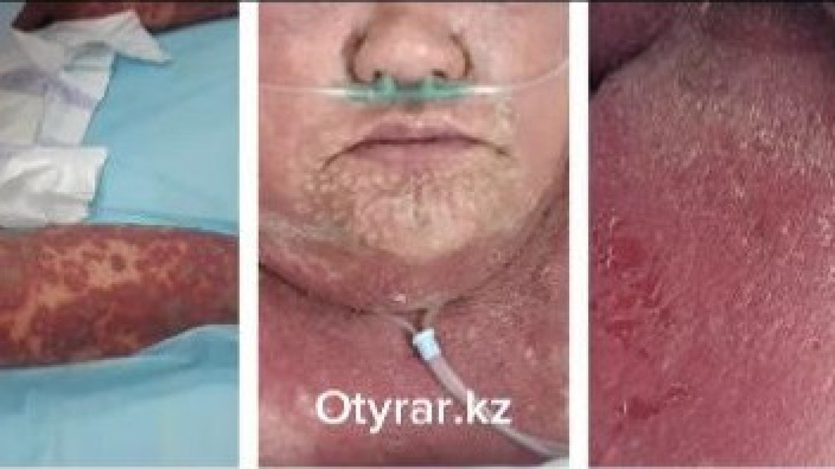 Казахстанка оказалась в реанимации после приёма китайских препаратов