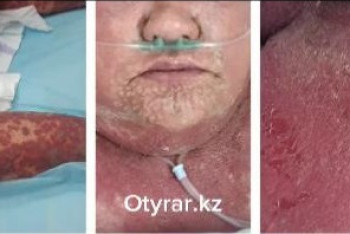 Казахстанка оказалась в реанимации после приёма китайских препаратов