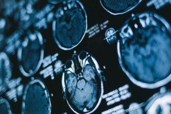 Житель Китая прожил с иглой в голове 20 лет