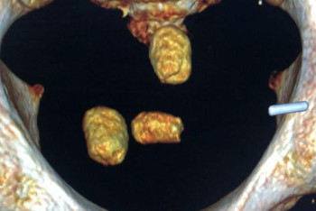 Килограмм наркотиков пытались провезти в желудке иностранцы в Актау