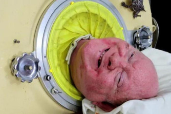 Фотография к новости: В США скончался один из последних пациентов "железных легких"