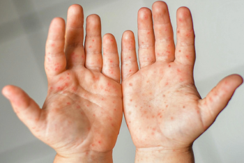 Фотография к новости: Коксаки в детсадах Астаны? В Минздраве ответили на тревогу родителей