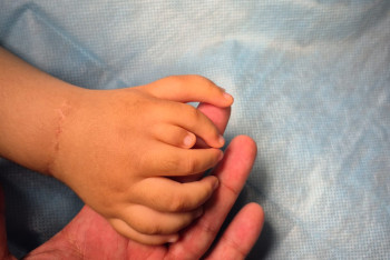 Малышу удалили лишние пальцы в Алматы, чтобы он мог держать игрушки